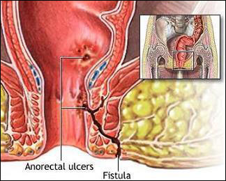 Fistula in Ano