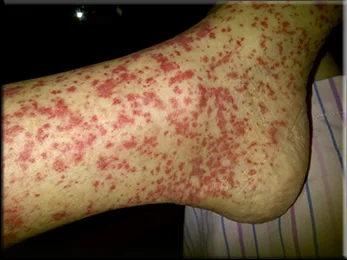 Leukocytoclastic Vasculitis (LCV)