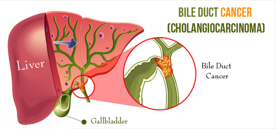 Bile Duct Cancer Bile Duct Cancer