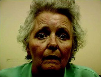 Progressive Supranuclear Palsy (PSP) Progressive Supranuclear Palsy