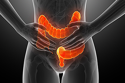 Ulcerative Colitis