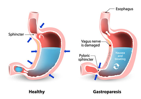 Gastroparesis