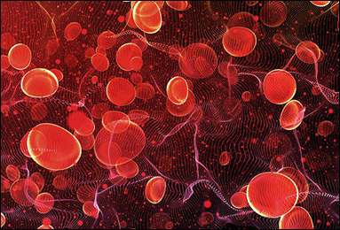 Hyponatremia (Low Blood Sodium)