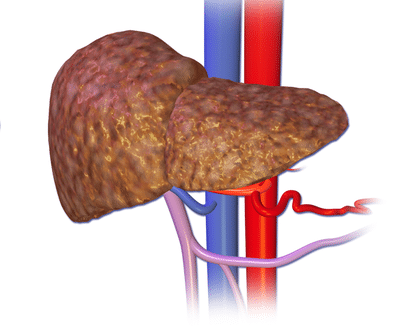 LIVER CIRRHOSIS