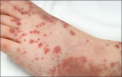 Idiopathic Thrombocytopenic Purpura