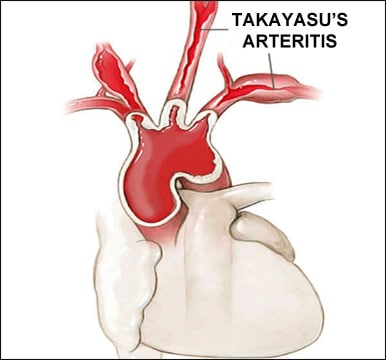 How to Treat Takayasu Arteritis in Ayurveda?