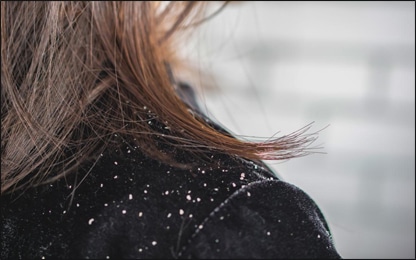 Dandruff or Hair Fall Dandruff, Hair Fall
