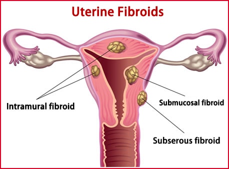 Uterine Fibroids