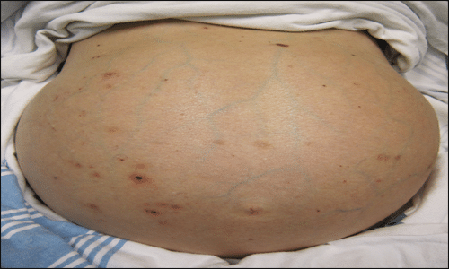 Ascites Ascites