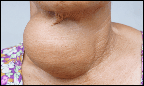 Hyperthyroidism Hyperthyroidism