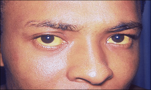 Jaundice Jaundice