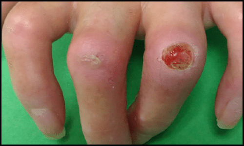 Scleroderma Scleroderma