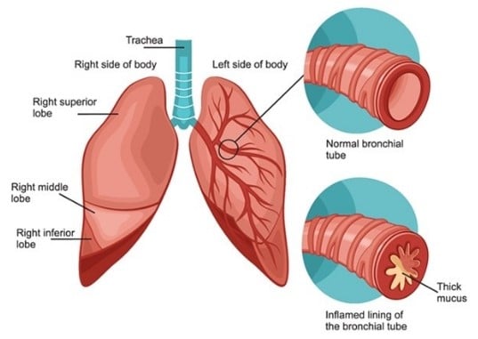 Allergic Bronchitis Ayurvedic treatment Ayurvedic Remedies for Allergic Bronchitis