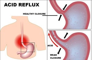 Ayurvedic Remedies for Acid Reflux