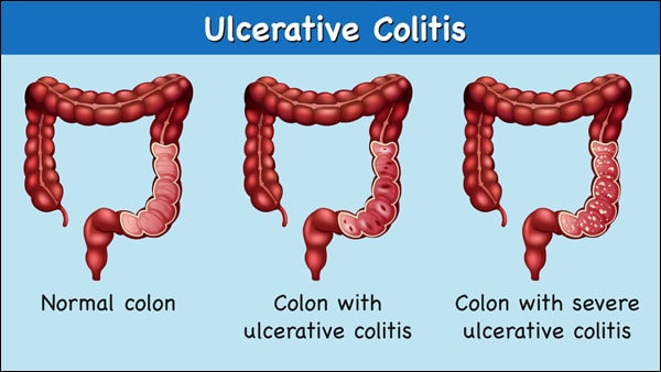 Colon with Ulcerative colitis