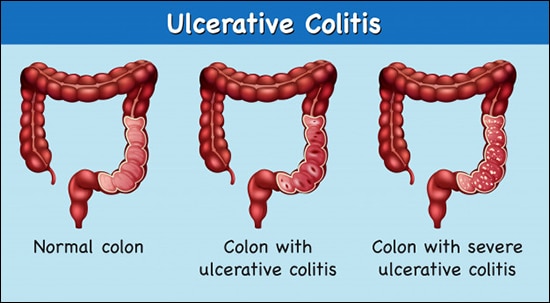 Ayurveda And Ulcerative Colitis
