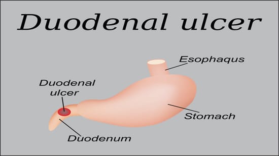 Duodenal Ulcers, Ayurvedic point view on duodenal ulcers