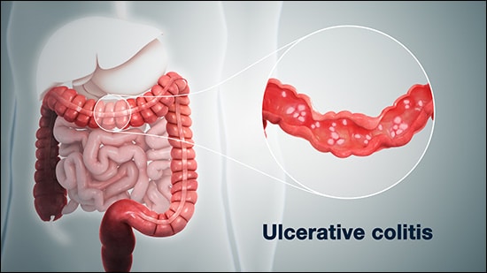 Ulcerative colitis Ulcerative colitis, Bloody diarrhea, Weakness, Mucus in stool, Weight loss, Abdominal pain, Abdominal cramps