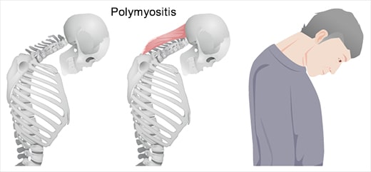 Polymyositis Polymyositis