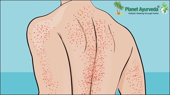 Idiopathic Thrombocytopenic Purpura ITP, Idiopathic Thrombocytopenic Purpura, Immune thrombocytopenic purpura