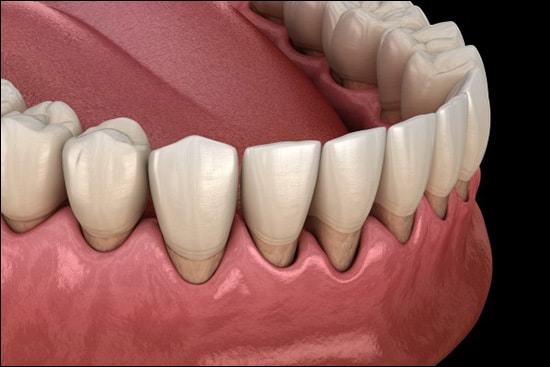 Receding Gums Receding Gums