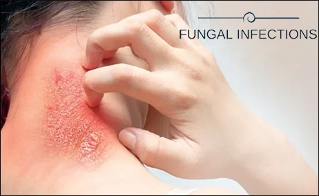 Fungal Infections, Ayurvedic point view on fungal infections