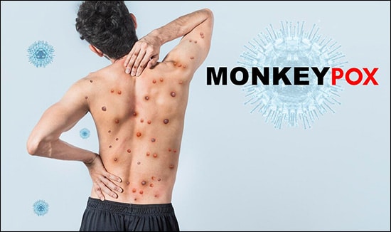 Monkeypox virus Monkeypox virus