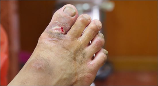 Gangrene