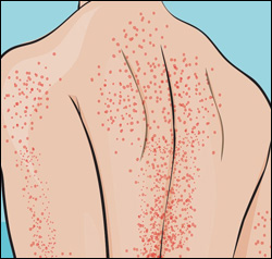 Idiopathic Thrombocytopenia Constipation