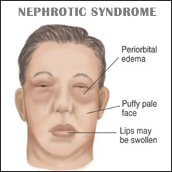 Nephrotic Syndrome Constipation