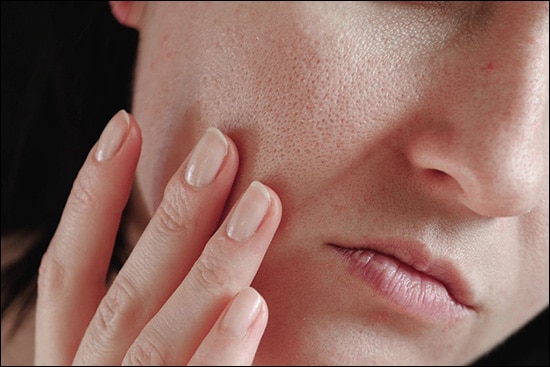 Dry skin, Natural tips, Natural treatment, Treat dry skin naturally