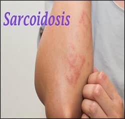 Sarcoidosis Sarcoidosis