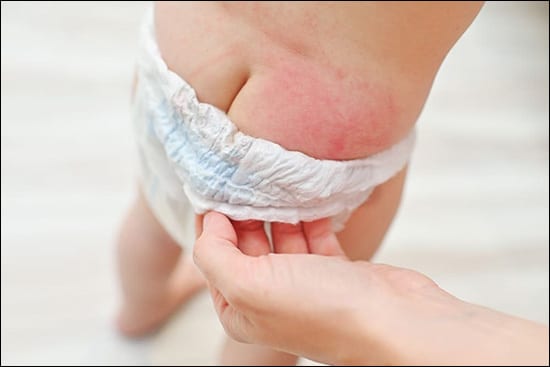 Diaper Rash Diaper Rash
