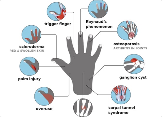 Crest Syndrome Crest Syndrome, Causes of Crest Syndrome, Diagnosis of Crest Syndrome, Symptoms of Crest Syndrome, Ayurvedic Treatment For Crest Syndrome, Herbal Remedies For Crest Syndrome, Ayurveda Aspect For Crest Syndrome, Herbal Remedies By Planet Ayurveda, Ayurvedic Herbs, Natural Treatment