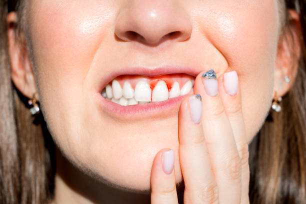 home remedies for scurvy