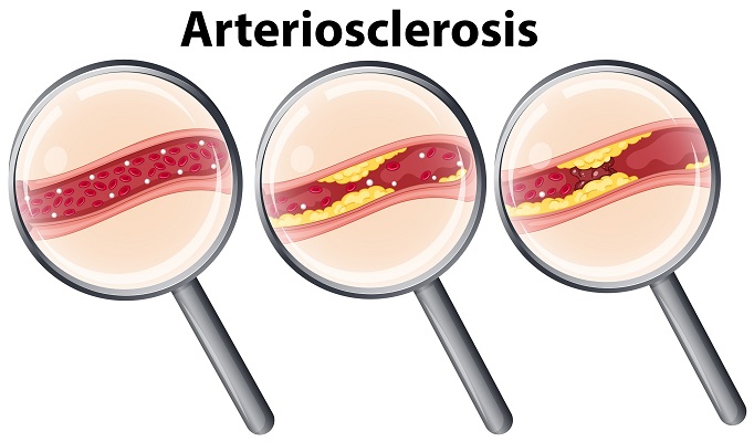 Home Remedies for Arteriosclerosis