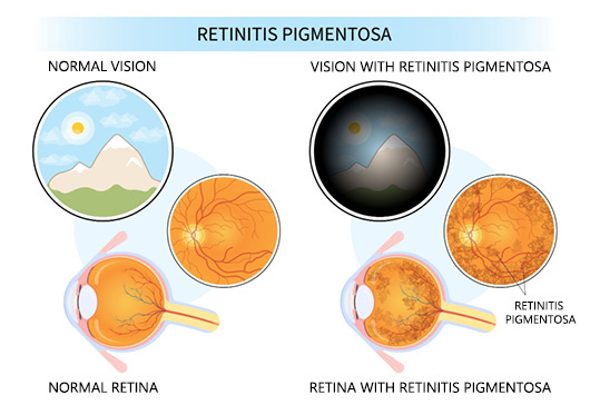Retinitis Pigmentosa