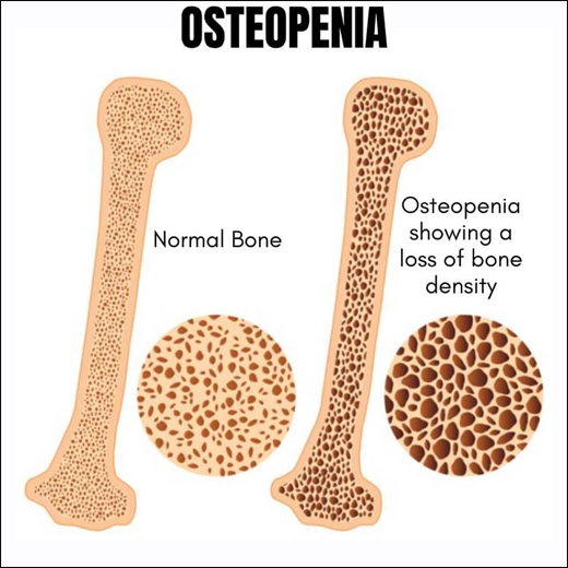 Osteopenia Osteopenia