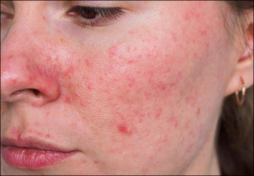 Acne Rosacea