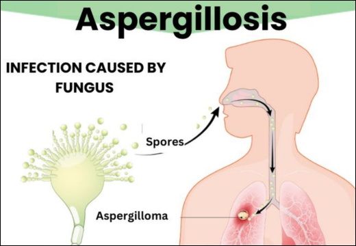 Aspergillosis Aspergillosis