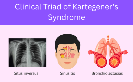 Kartagener’s Syndrome – Causes, Symptoms, Treatment & Herbal Remedies