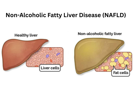 Non-Alcoholic Fatty Liver Disease (NAFLD)