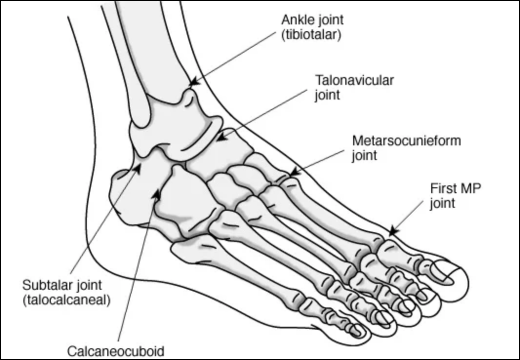Talonavicular Arthritis