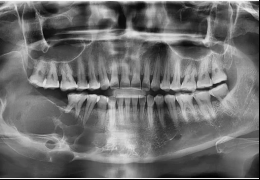Ameloblastoma