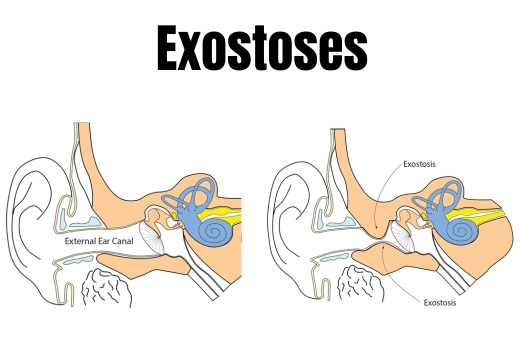 Exostoses