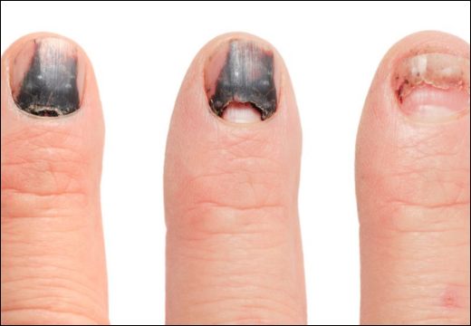 Glomus Tumor Glomus Tumor