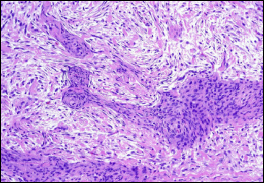 Hemangiopericytoma (HPC)
