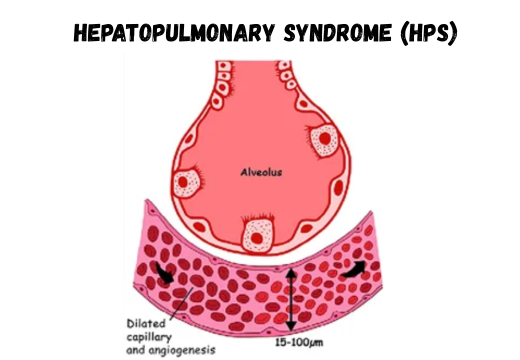 Hepatopulmonary Syndrome (HPS) Hepatopulmonary Syndrome (HPS)