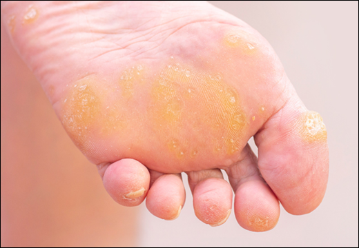 Hyperkeratosis