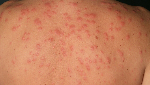 Herbal Remedies For Sweet Syndrome, Sweet Syndrome Causes, Sweet Syndrome Symptoms, Ayurvedic Management of Sweet Syndrome, Sweet Syndrome Ayurvedic Treatment, Inflammatory disorders, Acute febrile neutrophilic dermatosis, Sweet Syndrome diagnosis